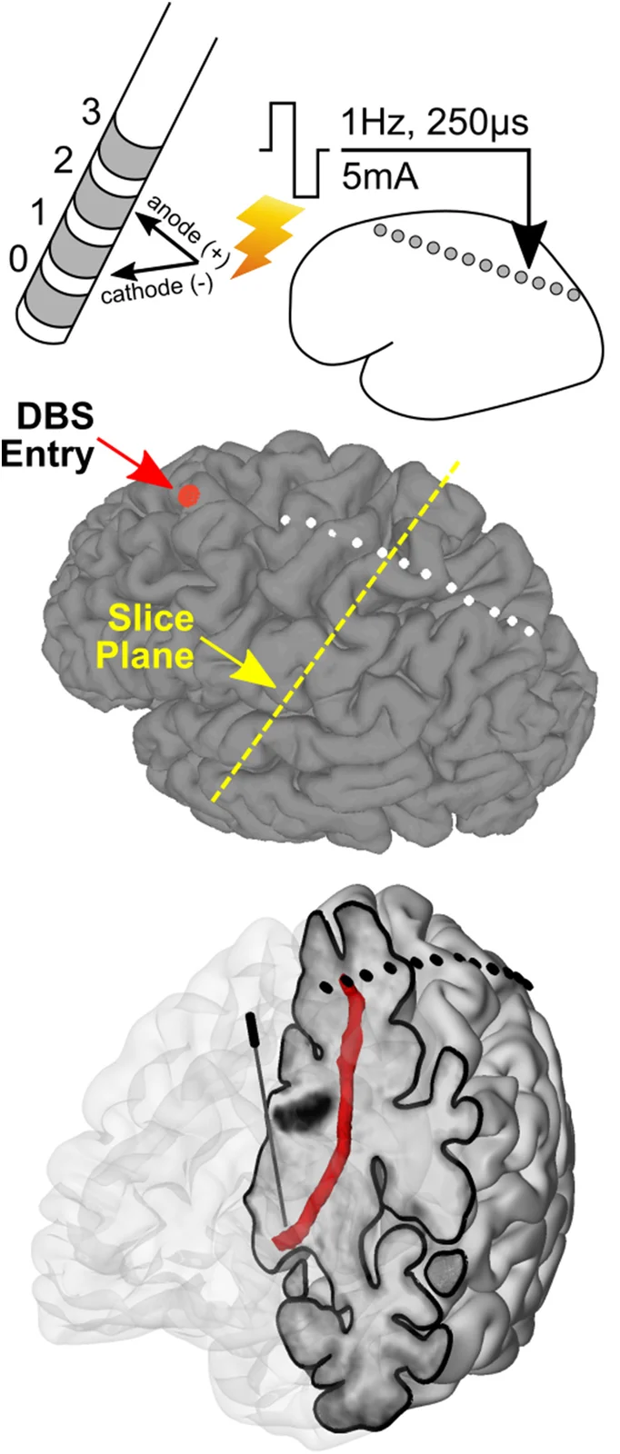 Thalamo-cortical evoked potentials during stimulation of the dentato-rubro-thalamic tract demonstrate synaptic filtering - Figure 1